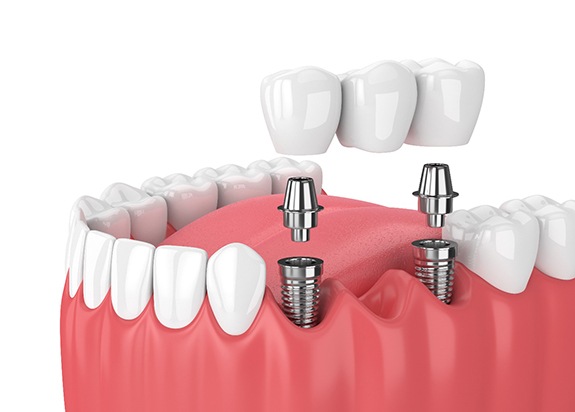 Illustration of dental bridge with implants in Fresno, CA for lower arch