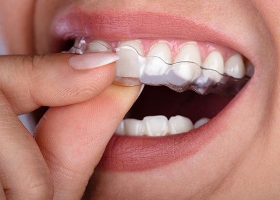 Closeup of patient placing Invisalign clear aligners