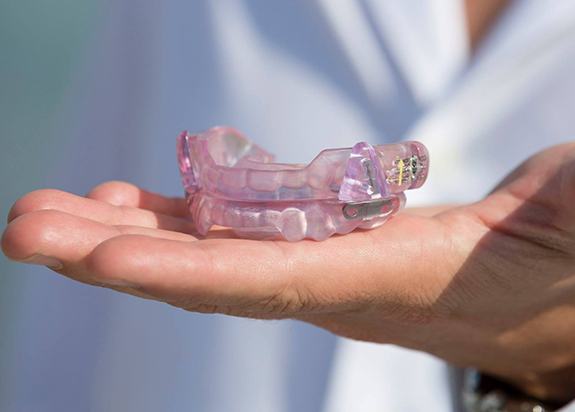 Hand holding a SomnoDent oral appliance for sleep apnea