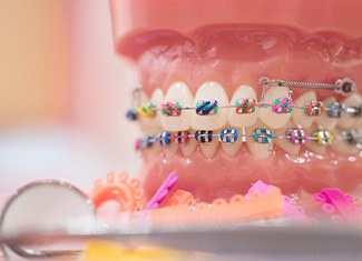 Model teeth with braces and bands in various colors