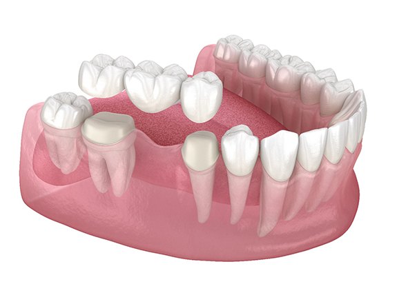 Illustration of dental bridge in Fresno, CA for lower arch