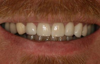 Bright healthy smile after teeth whitening