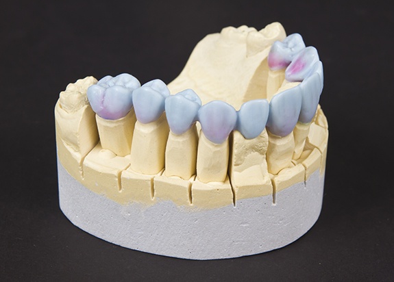 Model smile with dental implant supported denture in place