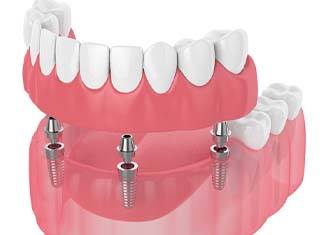 Digital illustration of implant dentures in Fresno