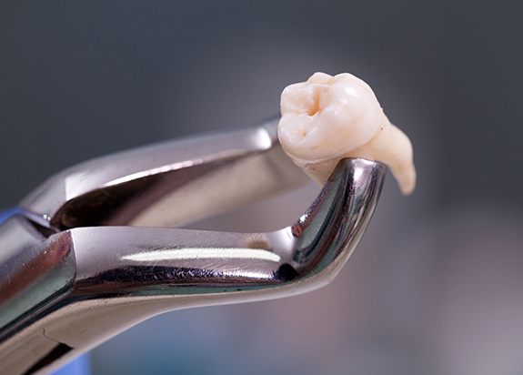 Metal clasp holding extracted tooth