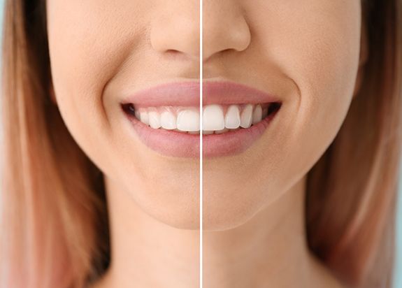 A woman’s smile before and after a gum recontouring treatment
