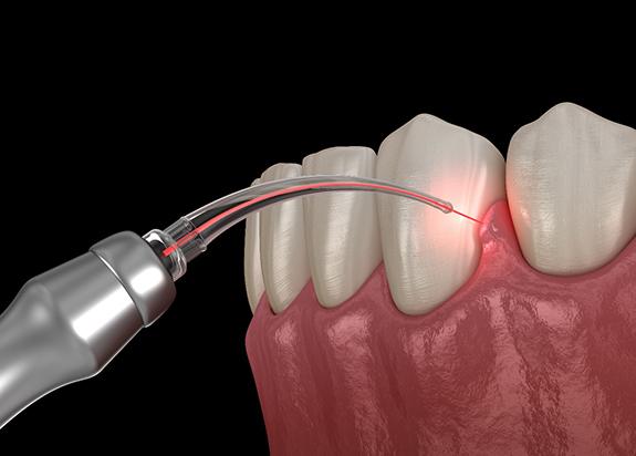 A 3D illustration of a gum recontouring treatment