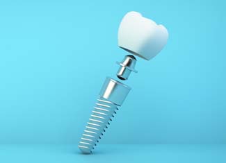 Dental implant in Fresno 