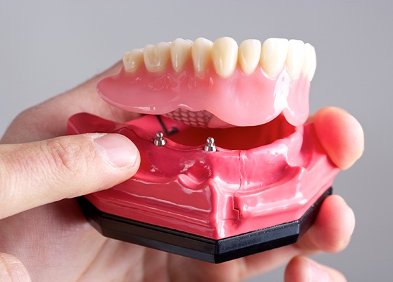 Model dental implant supported denture