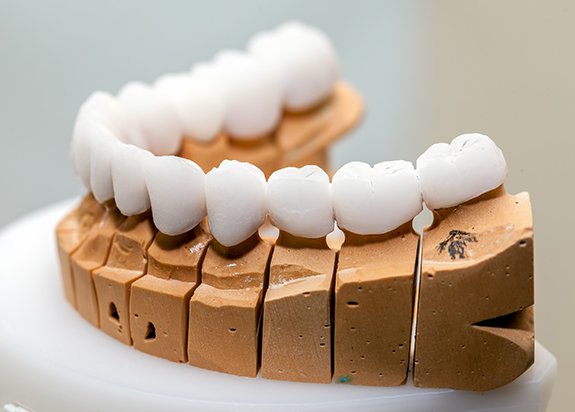 Model smile with dental implant supported denture