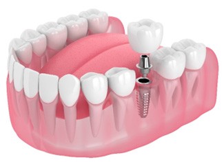 Illustration of single dental implant on bottom teeth