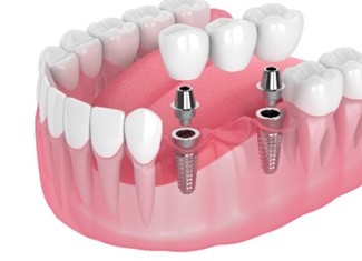 Illustration of dental bridge being placed on bottom teeth