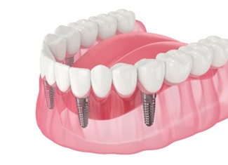 Illustration of implant denture being placed on bottom teeth