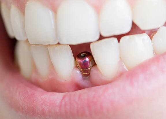 Closeup of dental implant in Fresno after surgery