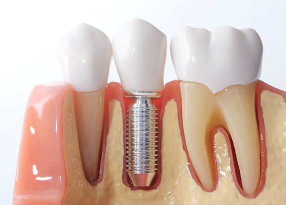 dental implant model