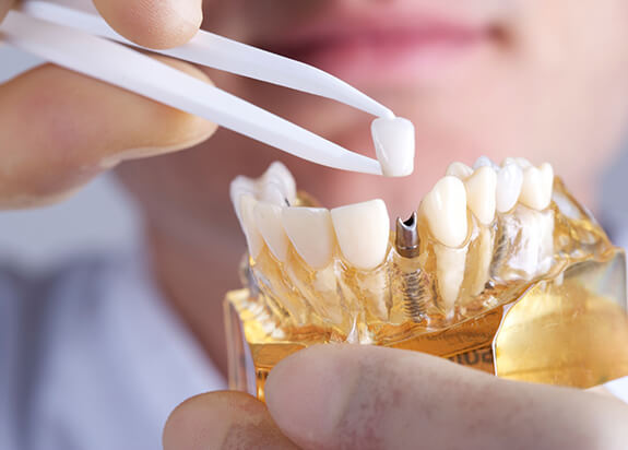 dentist placing a crown on top of a dental implant