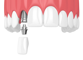 dental implant being placed in the upper jaw