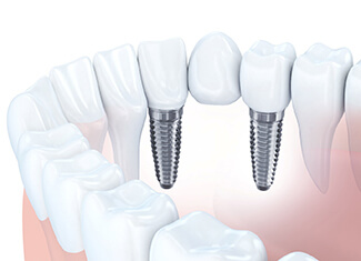 two dental implants supporting a dental bridge