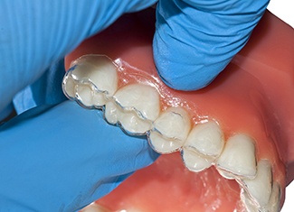 Clear aligner over dental mold