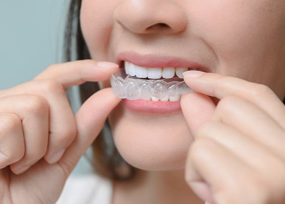 Closeup of patient placing an Invisalign tray