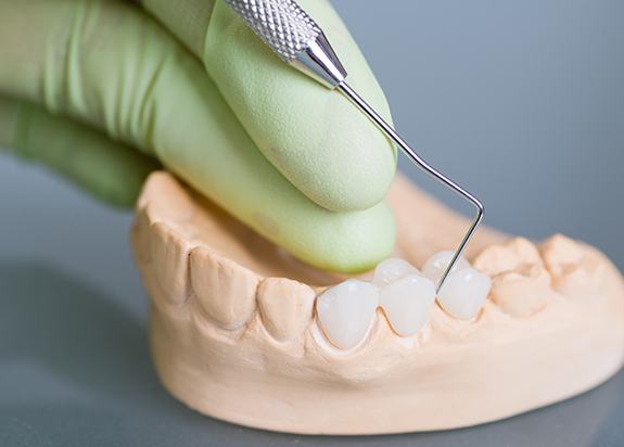 Model smile with dental bridge restoration