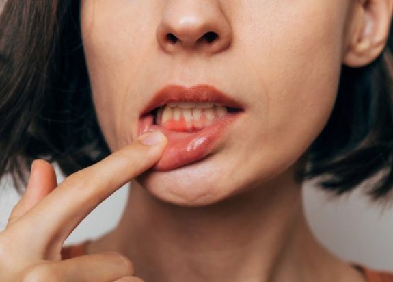 Lady shows gum inflammation