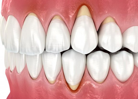 Illustration of gum recession