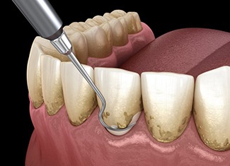 a 3D illustration of scaling and root planing
