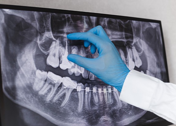 X-ray of a tooth in need of root canal therapy