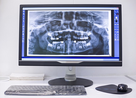 Digital x-rays on chairside computer monitor