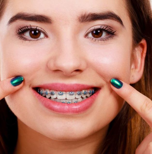 Smiling woman showing off her traditional braces in Fresno