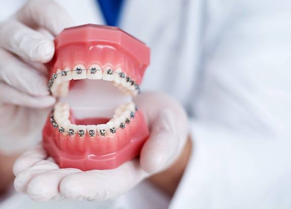 Gloved hands holding dental model with braces