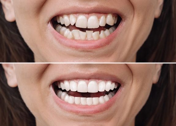 Woman’s teeth before and after orthodontic treatment