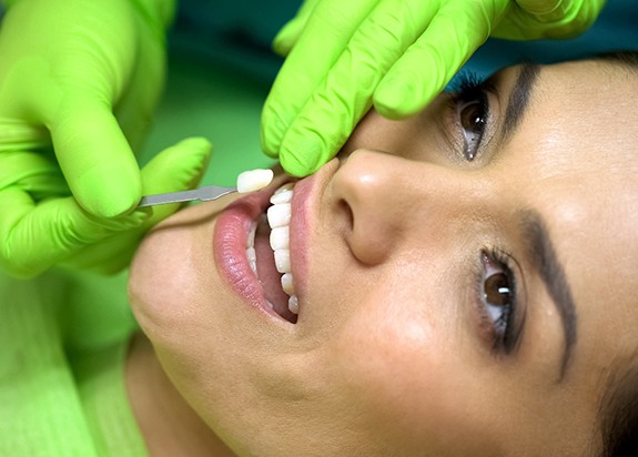 Woman having veneers in Fresno placed