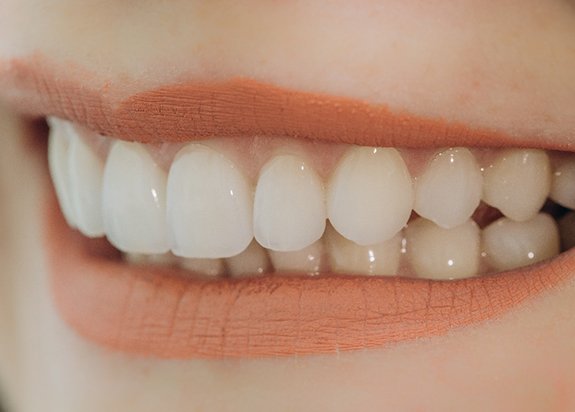 Closeup of woman smiling with veneers in Fresno