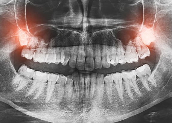 X-ray of smile with impacted wisdom teeth