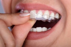 person removing Invisalign in Fresno