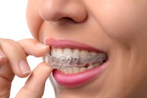 Woman wearing clear dental aligners