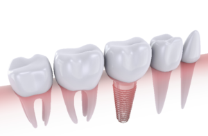 digital image of dental implants