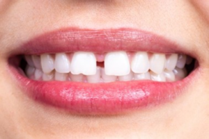 a closeup of a smile with a diastema 