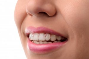 woman smiling with Invisalign aligner inserted